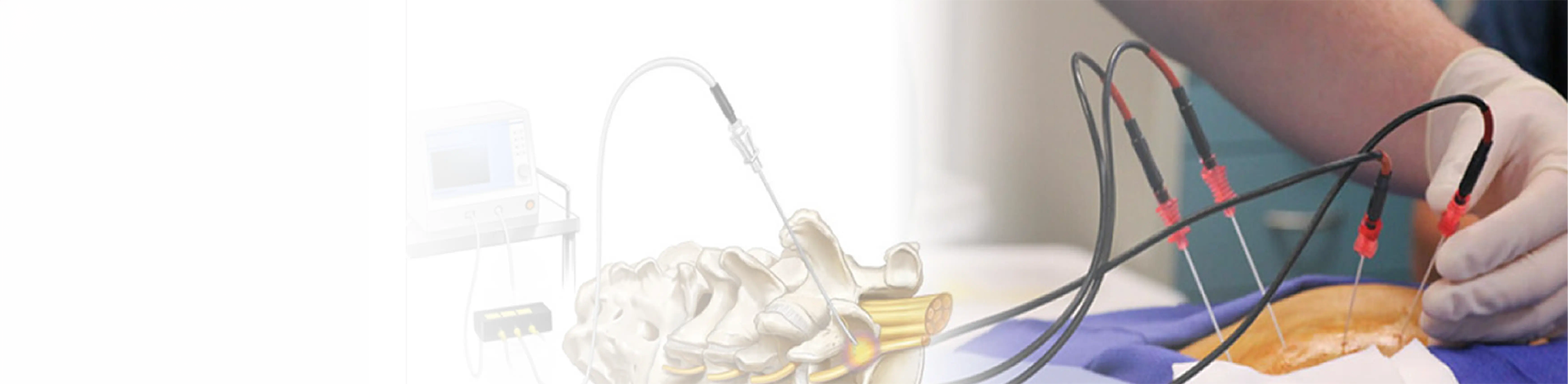 Radiofrequency Ablation (RFA)