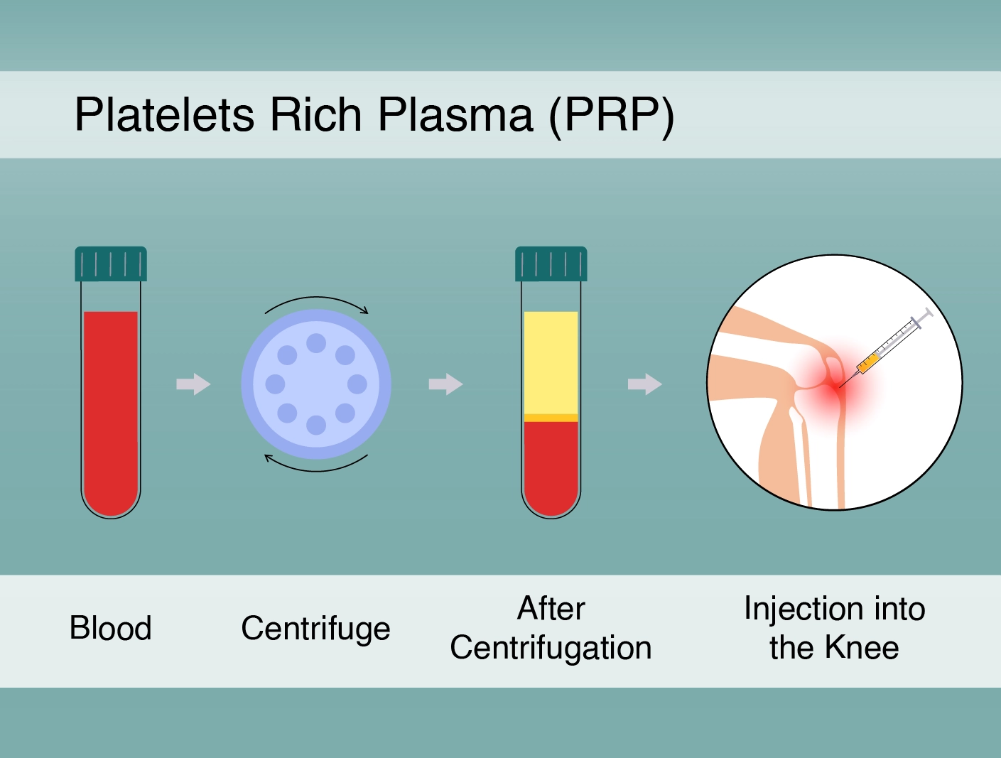 Joint injections